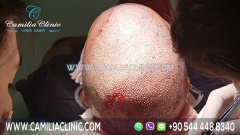 Hair Transplant in Turkey - Camilia Clinic